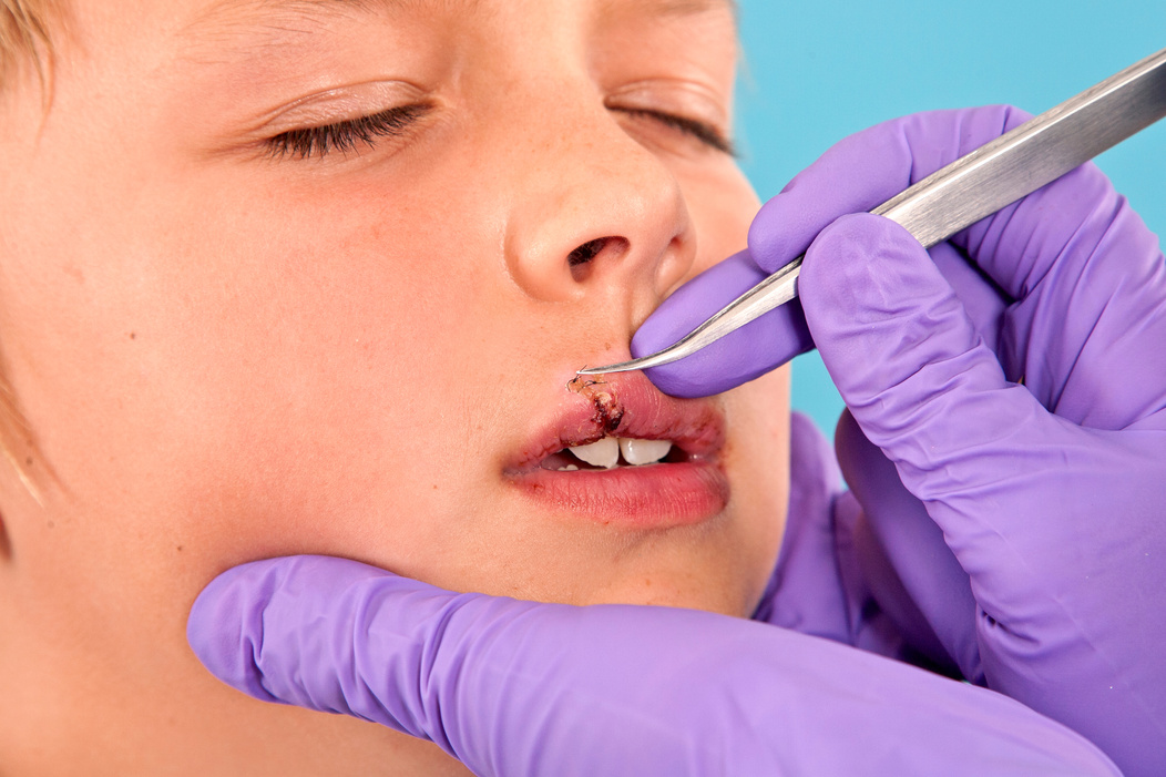 Removal of Stitches